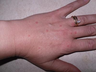 Skin Rash Health Question